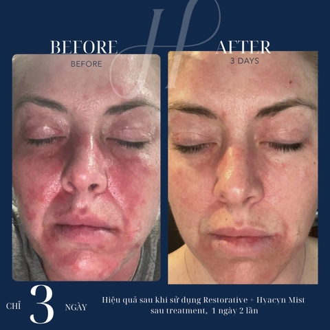 HYDRINITY Restorative HA Serum: Tinh Chất Cấp Ẩm Chuyên Sâu, Phục Hồi Tức Thì Với HA Siêu Nạp