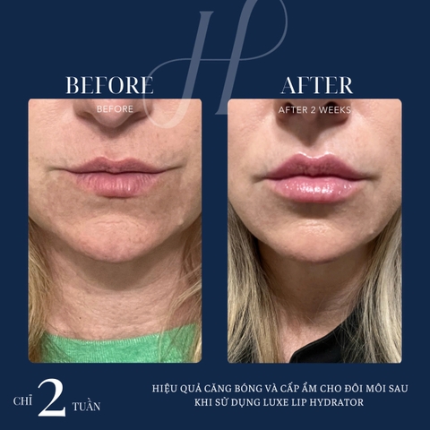 HYDRINITY LUXE LIP HYDRATOR: Khoa Học Gặp Gỡ Sang Trọng - "Filler Không Tiêm" Cho Đôi Môi Căng Mọng