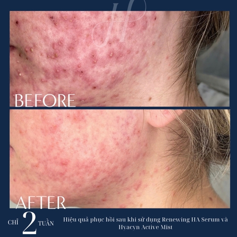 HYDRINITY HYACYN ACTIVE MIST: Tinh Chất Phục Hồi & Cân Bằng pH Với HOCl – Giải Pháp Cho Làn Da Nhạy Cảm, Tổn Thương