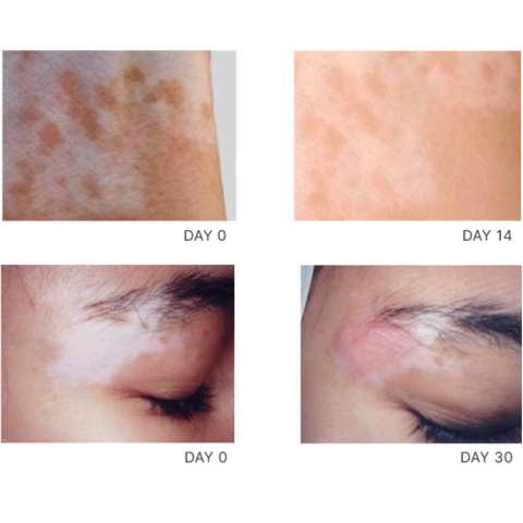 VITILSI Gel – Giải Pháp Chuyên Sâu Hỗ Trợ Điều Hòa Sắc Tố, Tái Tạo Vùng Da Bạch Biến