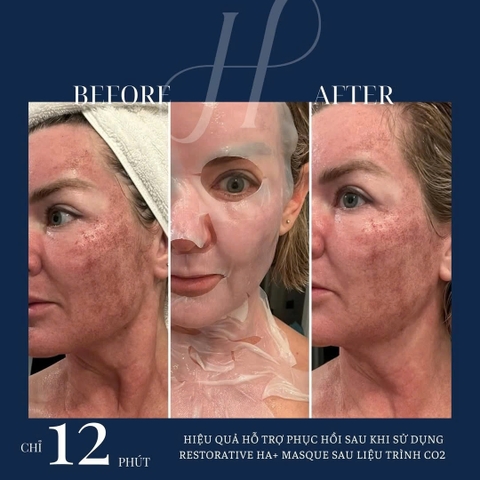Hydrinity Restorative HA+ Masque: Mặt Nạ Phục Hồi Cao Cấp - "Lớp Da Thứ Hai" Tái Sinh Làn Da Tổn Thương
