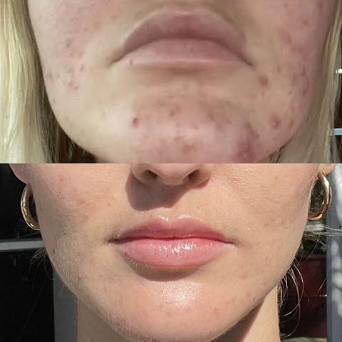 Neova Microfoliant Cleanser: Sữa Rửa Mặt Tẩy Tế Bào Chết Hóa Học Chuyên Sâu