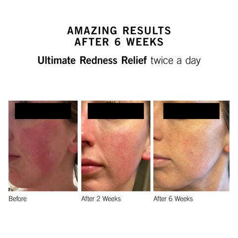 Neova Ultimate Redness Relief: Kem Dưỡng Phục Hồi Giảm Đỏ & Tái Tạo DNA