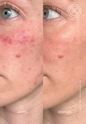 THERAMID CERAMIDE TREATMENT - Phức Hợp Phục Hồi Với Ceramide Nồng Độ Tăng Cường: Chìa Khóa Vàng Cho Làn Da Khỏe Mạnh, Mịn Màng