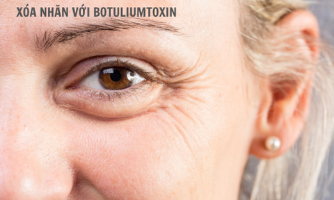 Xóa nhăn với Botox Hàn