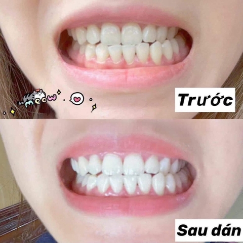 Set dán trắng răng Crest 3D 30 gói (Profes + Remove)