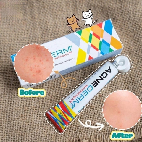 Chấm mụn Acnederm