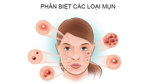 Các loại mụn thường gặp và cách chăm sóc hiệu quả