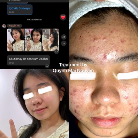 Hành Trình Chữa Mụn Tuổi Dậy Thì: 3 Buổi Peel Strong, Da Sạch Mụn Rạng Ngời