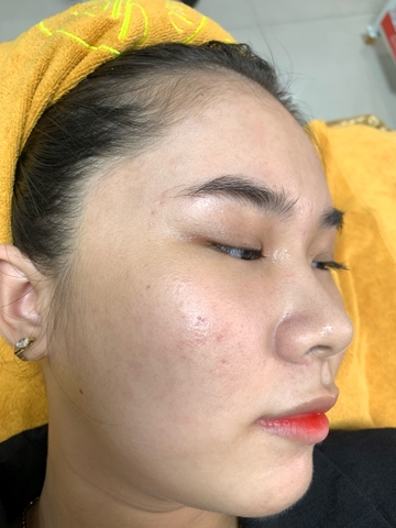 Điều trị mụn da dầu cho chị Thuỳ Dương tại Art Beauty