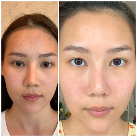 Điều trị mụn da dầu cho chị Trang Linh tại Art Beauty