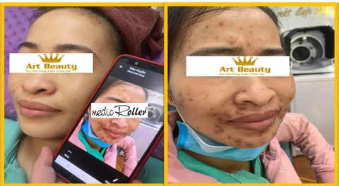 Điều trị thâm sau mụn thành công cho chị Hạnh tại Art Beauty