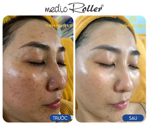 Giải cứu làn da nhiễm Corticoid: Bí quyết Detox hiệu quả từ Artbeauty