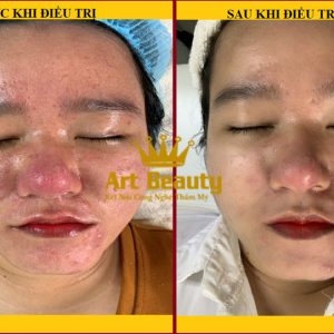 Điều trị mụn da dầu thành công cho chị Thanh Tâm tại Art Beauty