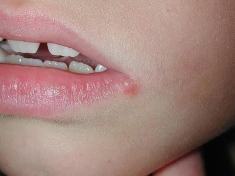 Mụn ở môi: Nguyên nhân, cách điều trị và phòng ngừa hiệu quả