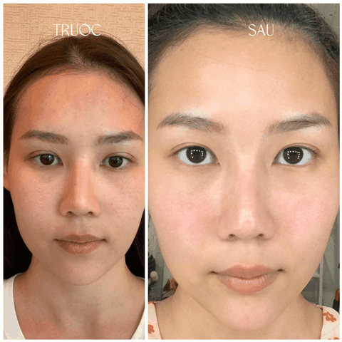 Dịch vụ Giảm Thâm sau mụn