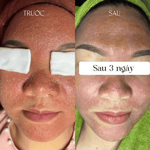 Dịch vụ giảm nhiễm Corticoid