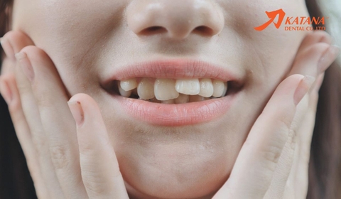Răng cửa mọc lệch: Phân loại, nguyên nhân & cách khắc phục