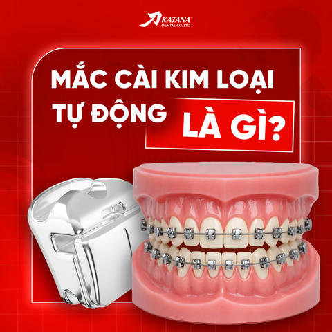 Mắc cài kim loại tự động là gì? Ưu điểm và hạn chế