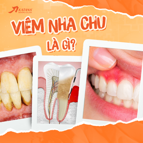 Viêm nha chu là gì? Dấu hiệu, nguyên nhân và cách điều trị
