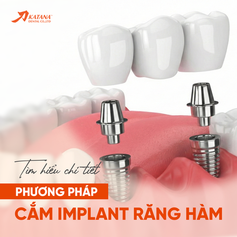 Tìm hiểu chi tiết về phương pháp cắm Implant răng hàm