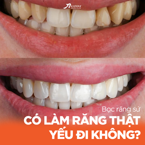 BỌC RĂNG SỨ CÓ LÀM RĂNG THẬT YẾU ĐI - SỰ THẬT KHÔNG PHẢI AI CŨNG BIẾT?