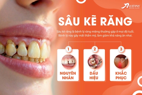 Sâu răng kẽ là gì? Dấu hiệu, nguyên nhân và cách khắc phục