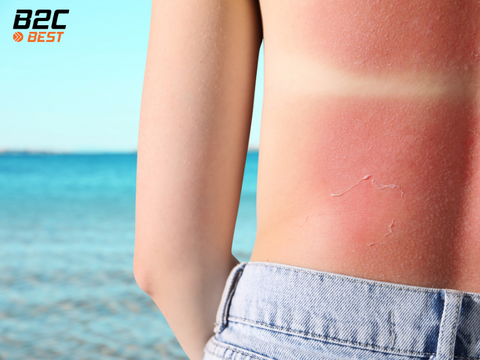 Chăm Sóc Da Khi Bị Cháy Nắng Sau Khi Đi Biển