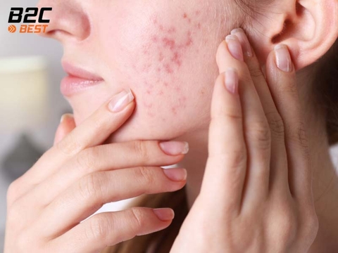 Cách Tẩy Da Chết Cho Da Mụn Đúng Chuẩn, Ngừa Thâm Và Ngừa Mụn Mới
