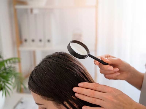 Hướng Dẫn Tẩy Tế Bào Chết Da Đầu Tại Nhà Đúng Cách