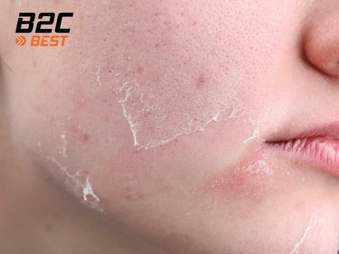 Vì Sao Da Dầu Vẫn Khô? Hiểu Đúng Để Chăm Sóc Da Chính Xác Hơn