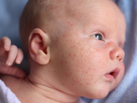 Cách phòng tránh rôm sảy cho bé trong mùa nắng nóng