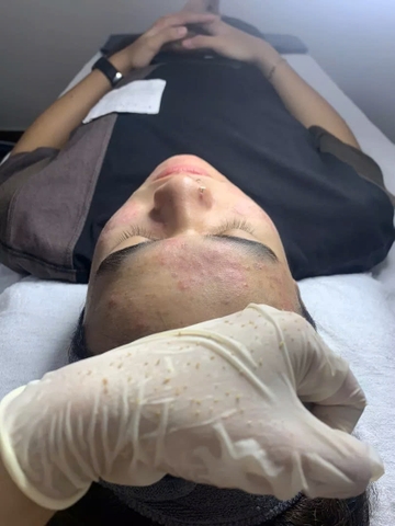 Ống hút mụn giá rẻ hà nội, spa trị mụn không thể bỏ qua