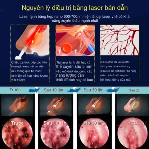 Máy Điều Trị Hỗ Trợ Viêm Mũi, Viêm Xoang Viêm Mũi Dị Ứng Bằng Sóng Hồng Ngoại Tặng Kèm Pin 9v