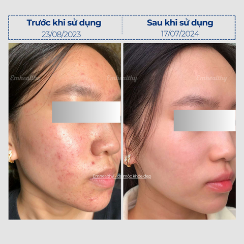 Combo 2 Chống nắng, hỗ trợ điều trị mụn và nám, phục hồi toàn diện tại nhà | Có HLV đồng hành 3 tháng