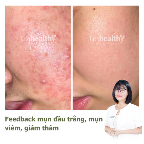 Gói Hỗ Trợ Điều Trị Mụn và Kiểm Soát Dầu 1 - 3 tháng| Dành cho da dày, khỏe (có chuyên viên theo dõi 1:1)