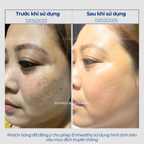 Combo 2 Chống nắng, hỗ trợ điều trị mụn và nám, phục hồi toàn diện tại nhà | Có HLV đồng hành 3 tháng