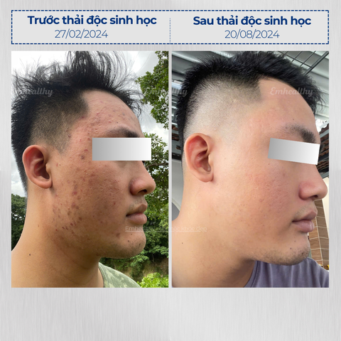 Vi sinh 2.7 dành cho da thường| Mỹ phẩm vi sinh Hoa Ngân