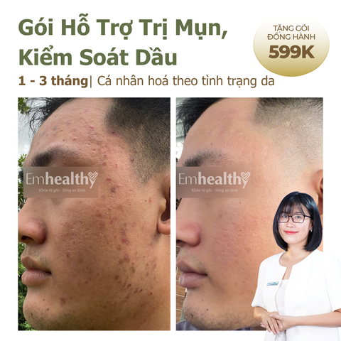 Gói Hỗ Trợ Điều Trị Mụn & Phục Hồi Nền Da 3 tháng tại nhà | có HLV sức khoẻ làn da đồng hành 1:1