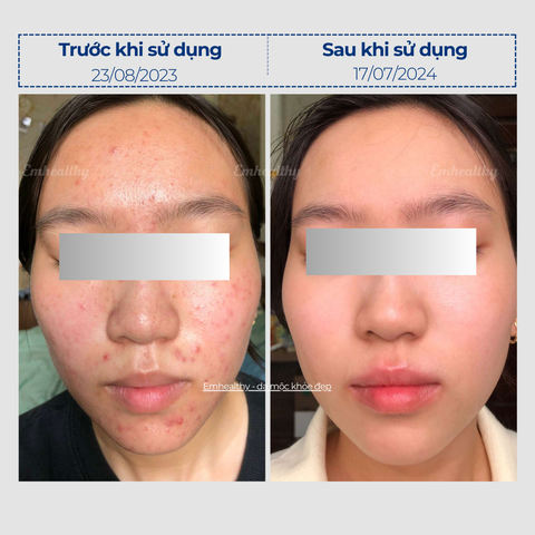 Combo 4 Hỗ Trợ Điều Trị Mụn, Nám & Phục Hồi Nền Da tại nhà | Có HLV đồng hành 3 tháng