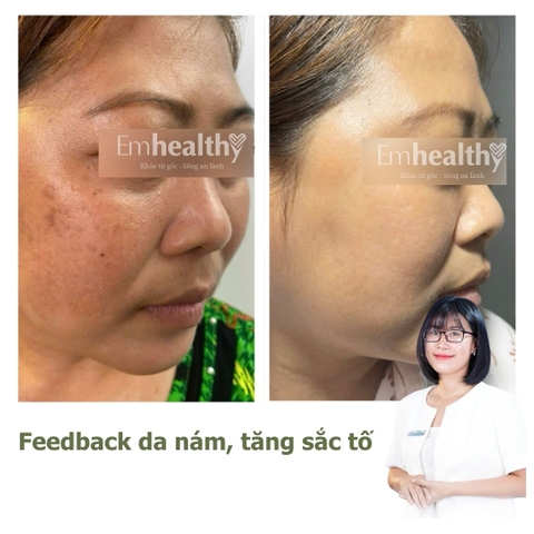 Gói Hỗ Trợ Điều Trị Nám 1 - 3 tháng| Dành cho da dày khoẻ (HLV làn da đồng hành 1:1)