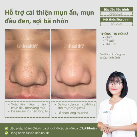Combo 2 Chống nắng, hỗ trợ điều trị mụn và nám, phục hồi toàn diện tại nhà | Có HLV đồng hành 3 tháng