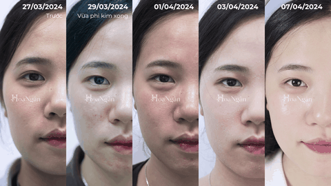 Vi sinh 2.0 dành cho da nhạy cảm| Mỹ phẩm vi sinh Hoa Ngân