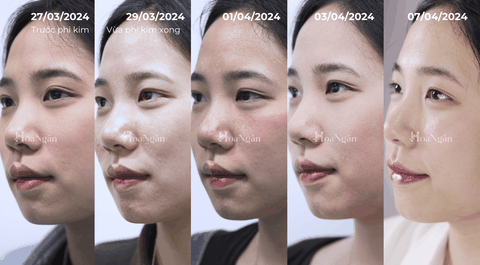 Vi sinh 2.0 dành cho da nhạy cảm| Mỹ phẩm vi sinh Hoa Ngân
