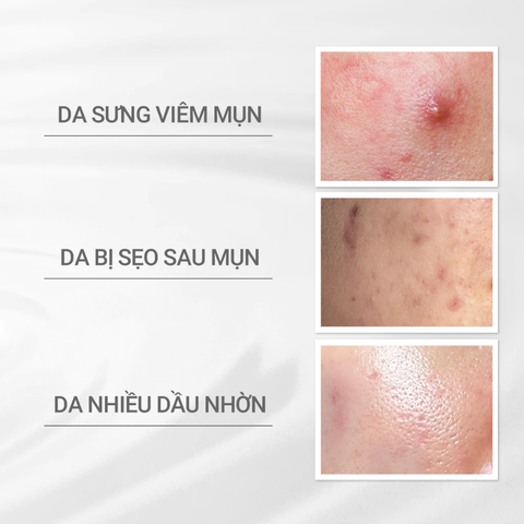 Sữa dưỡng ACNE CARE EMULSION CHĂM SÓC DA MỤN 125ml