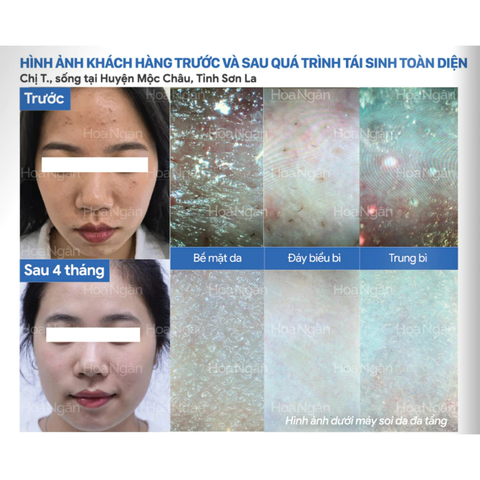 Combo 4 Tái Sinh Toàn Diện | Mỹ Phẩm Vi Sinh Hoa Ngân