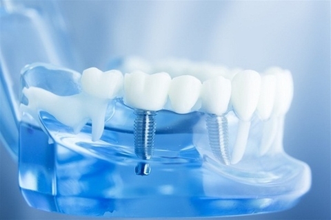 Chuyên gia lưu ý những yếu tố trước và sau khi cấy ghép Implant