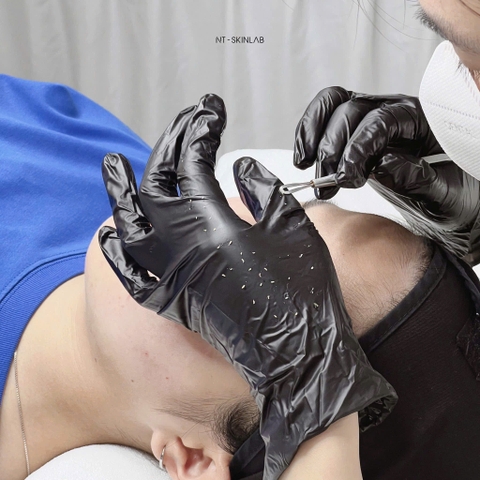 Cây nặn mụn 2 đầu cao cấp