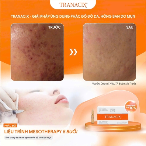 TRANACIX 10% – Liệu pháp tiêm giảm nám chuyên sâu
