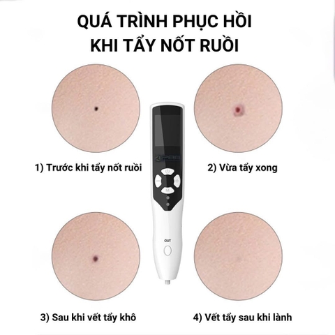 Máy Plasma Nhấn Mí TH COMPANY, Máy Đốt Nốt Ruồi Mụn Thịt Nám Tàn Nhang Có Tích Điện